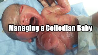 How to manage a Collodian Baby  Mothers Guide [upl. by Adlemy]