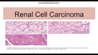 CT Kidneys and Bladder  Five pathologic cases discussed [upl. by Marta]