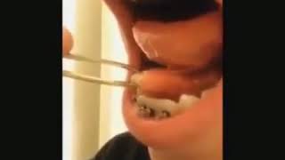 Sialolithiasis—Salivary duct stone removal [upl. by Aiet]