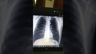 Pleural Effusion Final prof Xray interpretation [upl. by Gilbertine]