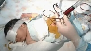 Newborn jaundice HyperbilirubinemiaWhat are the risk factors [upl. by Ainatnas]