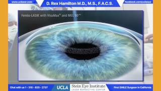 LASIK  Refractive Surgery  understand the procedure [upl. by Ecart531]