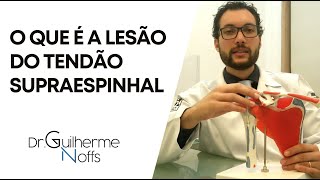 Lesão do Tendão Supraespinhal  Dr Guilherme Noffs [upl. by Salvador528]