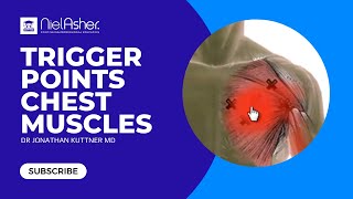 Chest Pain  Trigger Points [upl. by Akeihsal216]