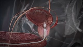 Prostate Cancer amp Disease – Symptoms Treatment amp Cure  Dr Vikas Jain  Narayana Health [upl. by Olegnalehcim]