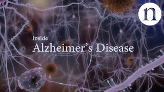 Inside Alzheimer’s disease [upl. by Rhee]