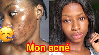 Comment se débarrasser de l’acné bouton et des points noirs sur le visage [upl. by Aneehsar]