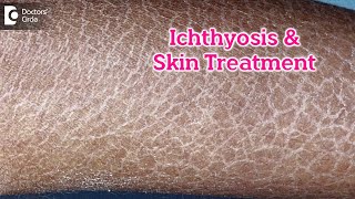 What is Ichthyosis How to Treat my Skin Fish like scales On SkinDrRasya Dixit  Doctors Circle [upl. by Emirak908]